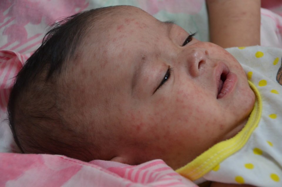 measles-960x636.jpg