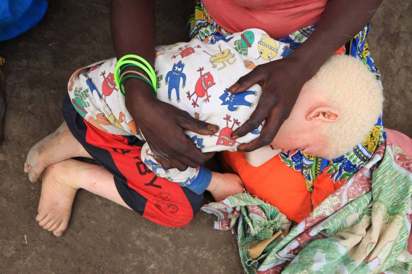 malawi-albino-child-death.jpg